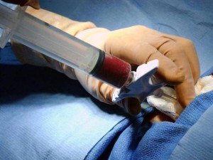 leucemia mieloide cronica