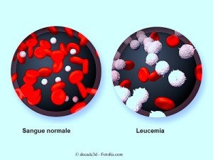 leucemia mieloide cronica