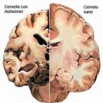 Alzheimer