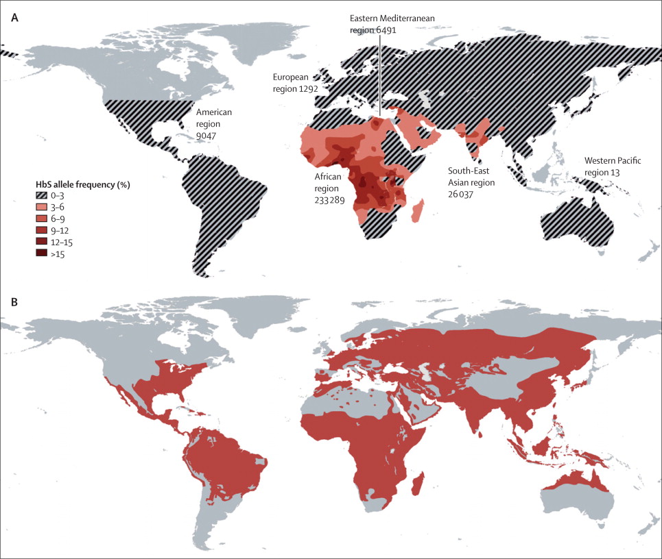 anemia falciforme