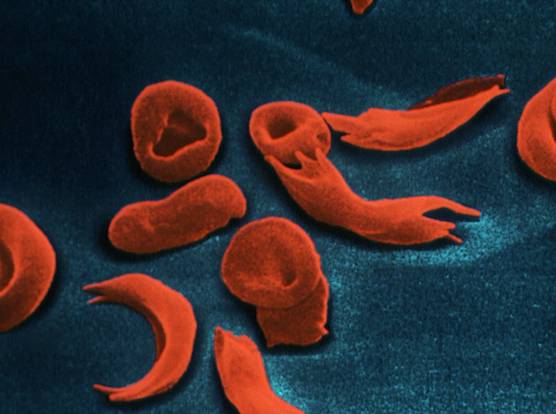 anemia falciforme