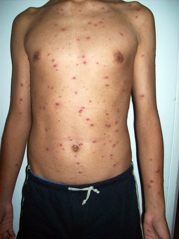 varicella