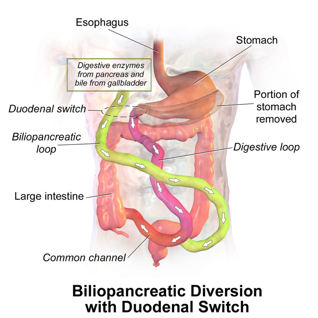 Diversione biliopancreatica