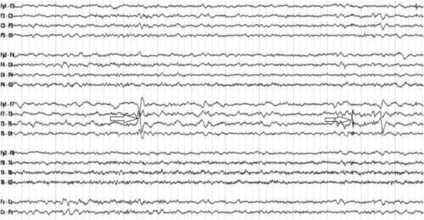 epilessia temporale